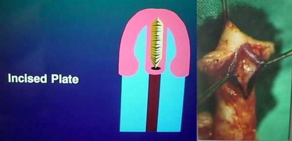 Ipospadia vergine - Incisione mediana del piatto uretrale e sua mobilizzazione.