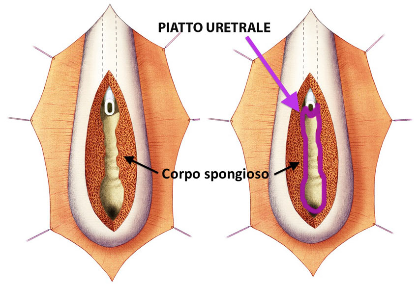 Apertura ventrale dell'Uretra ed esposizione del piatto uretrale
