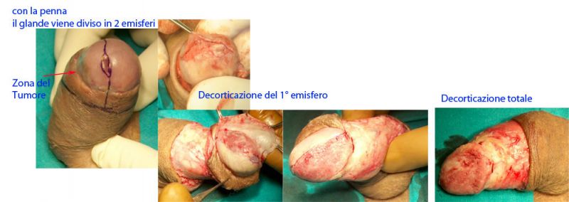 Tumore del pene - decortificazione del glande