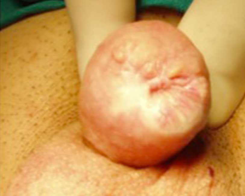 Tumore del pene - vecchia chirurgia mutilante