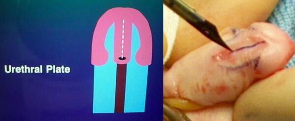 Disegno del piatto uretrale e della incisione mediana