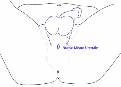 L’Uretra viene aperta e viene creato un nuovo Meato Uretrale sotto lo scroto
